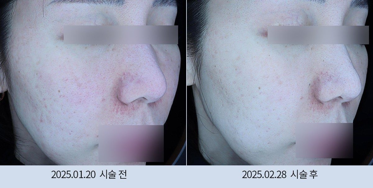 스노우의원 다산점 여드름·붉은기 시술 전후