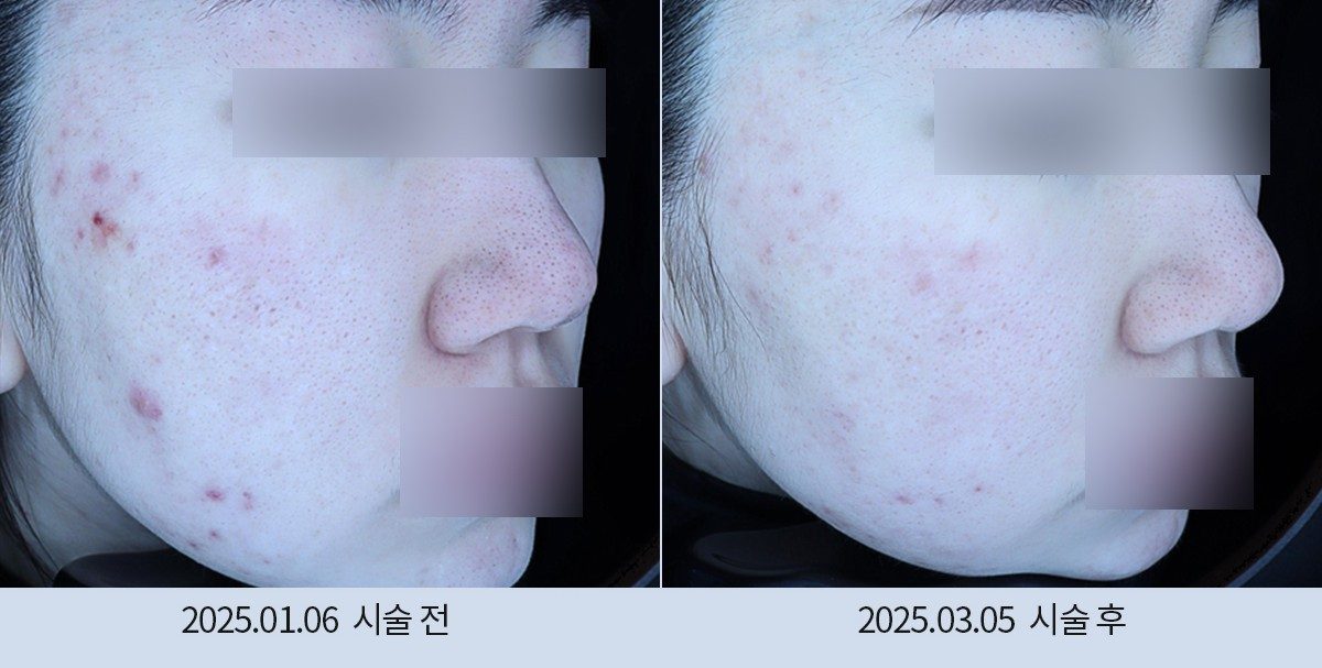 스노우의원 다산점 여드름·붉은기 시술 전후