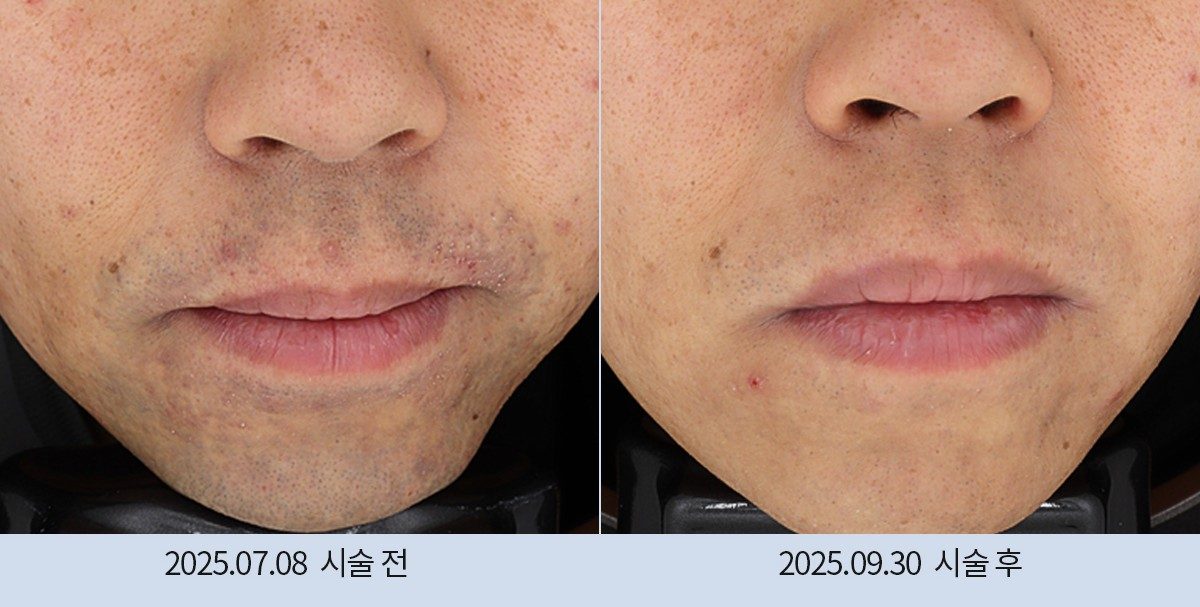스노우의원 다산점 레이저 제모 전후