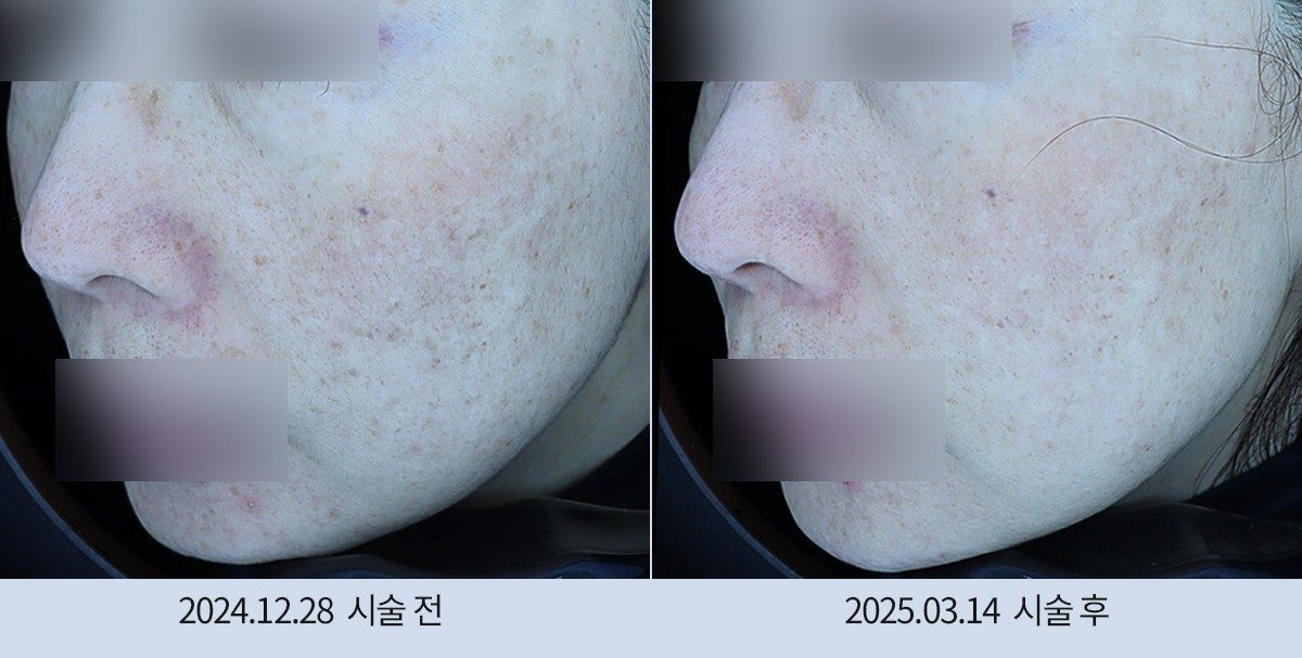 스노우의원 다산점 색소 시술 전후
